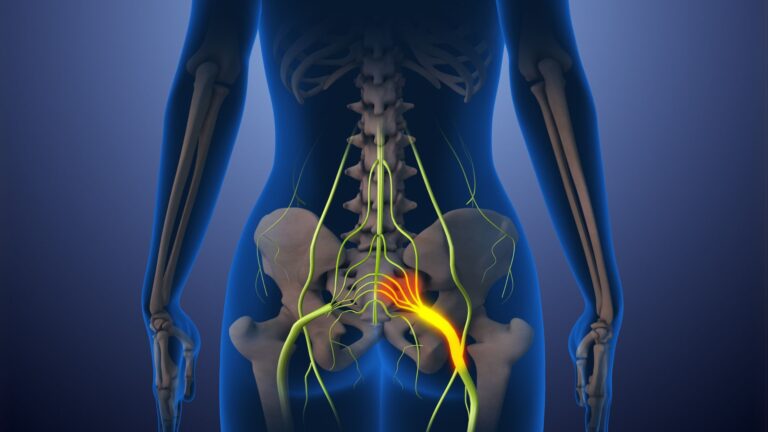 Sciatica Pain: Origins, and Causes